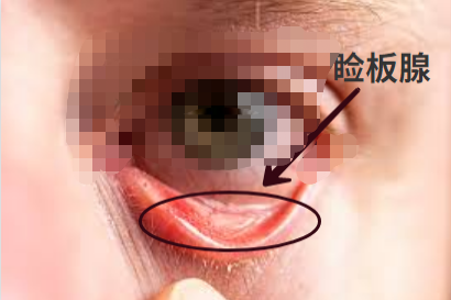 睑板腺位置图片