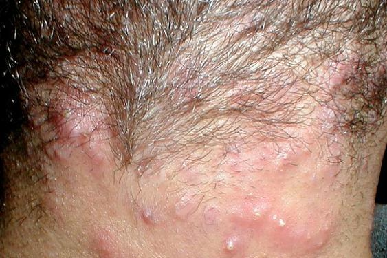 革兰阴性菌性毛囊炎图片