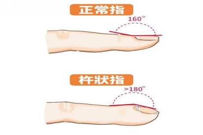 杵状指图片