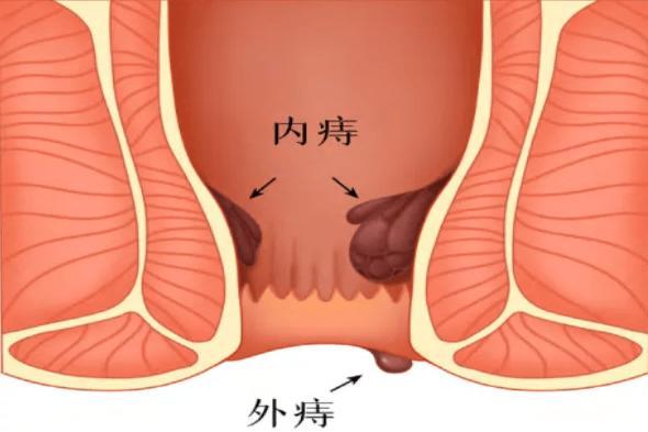 痔疮图片