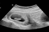 b超怀孕初期图片