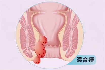 混合痔图片