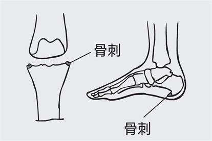 骨刺图片