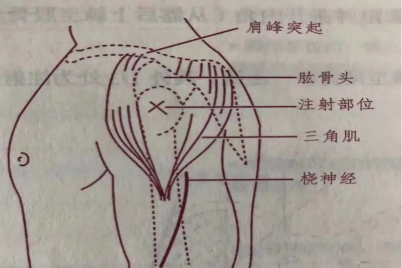 上臂三角肌注射示意图