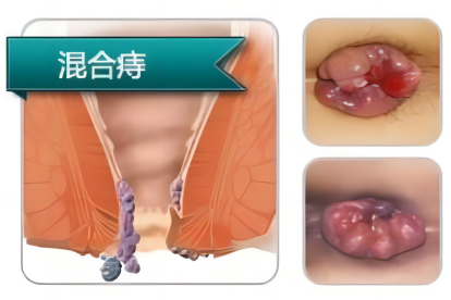 混合痔图片