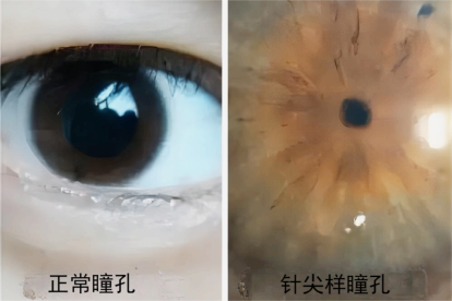 针尖样瞳孔图片