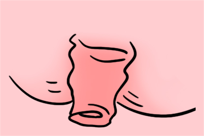 痔疮手术后3个月脱肛图片痔疮手术