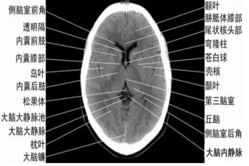 基底节CT解剖图片