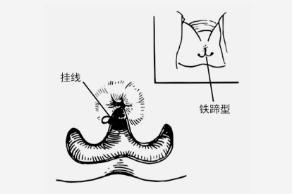 脱肛缝合方法图解图片