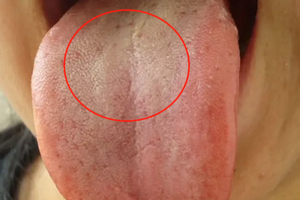 血糖高舌头有什么症状图片_瑞尔安心